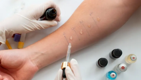 Allergy Skin Tests: How Doctors Find Out What You’re Reacting To