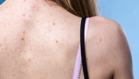 Body Acne on Back and Shoulders: Everyday Habits That Make It Worse