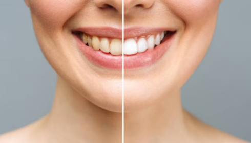 Hidden Sugar and Your Teeth: How Everyday Snacks Quietly Damage Enamel