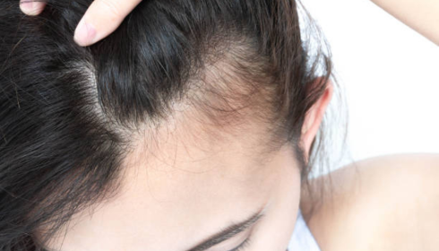 Hairfall During Seasonal Change: What’s Normal and When to Worry