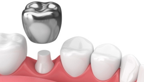 Metal Crowns vs Tooth-Coloured Crowns: Cost, Look and Durability Compared