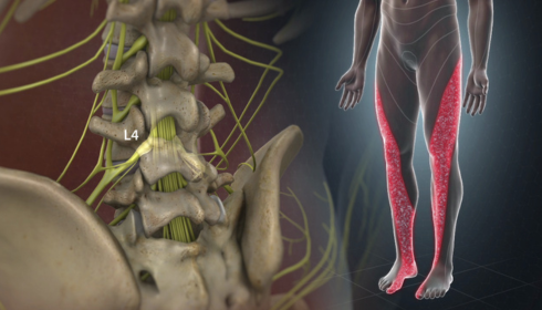 Getting to the Root of Sciatica: Why Treating the Nerve Matters More Than Masking the Pain